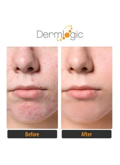 Dermlogic Acne Treatment Padscontains Glycolic Lactic Salicylic Acid. Eliminates Oily Skin Clogged Pores & Cystic Breakouts. Removes Dark Spots Whitehead & Blackhead Pimples For Face & Body.  - Image 4