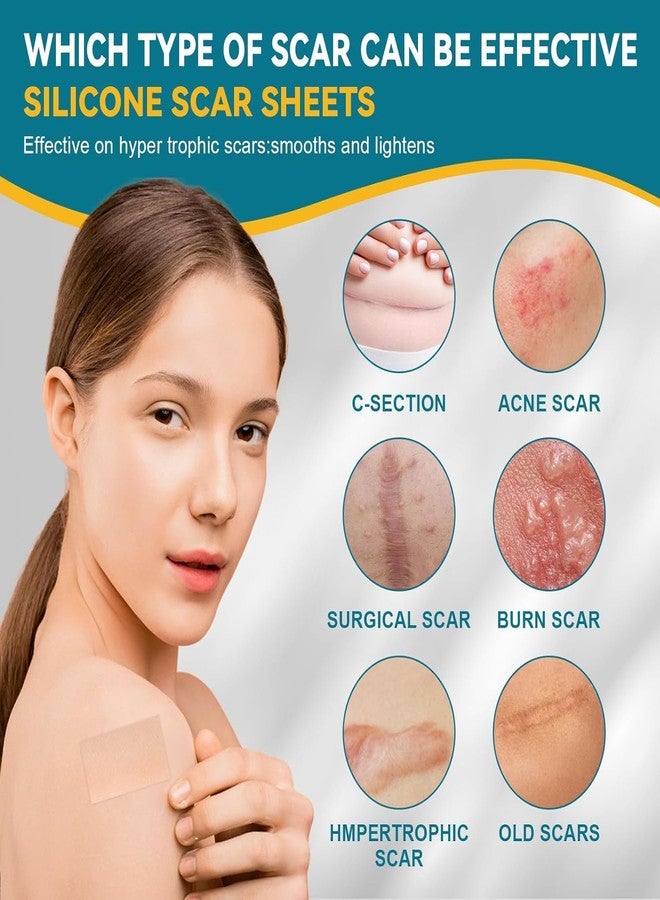 LINSIRON Silicone Scar Tape,Silicone Scar Sheets 1.6"X60" Roll,Reusable Medical Grade Scar Away Silicone Scar Sheets and Face Tape for Wrinkles, Keloid Scars, Hypertrophic Scars - Image 2