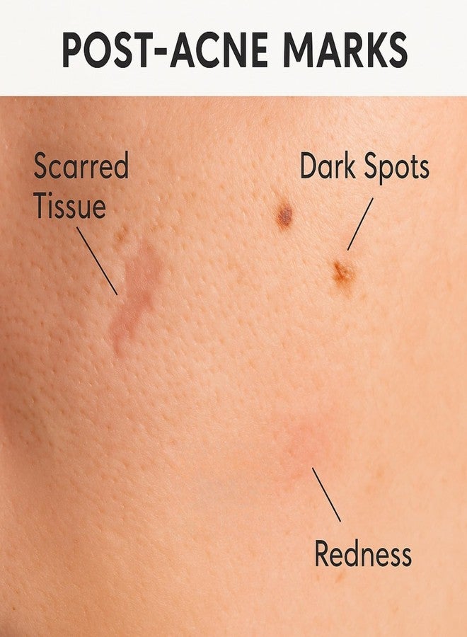 PUREEASE Acne Scar & Dark Spot Patches – Gentle Non-Adhesive Silicone Dots, Safe for Sensitive Skin – Ultra-Thin, Breathable & Nearly Invisible – 72 Pimple Patches, 2 Sizes - Image 4