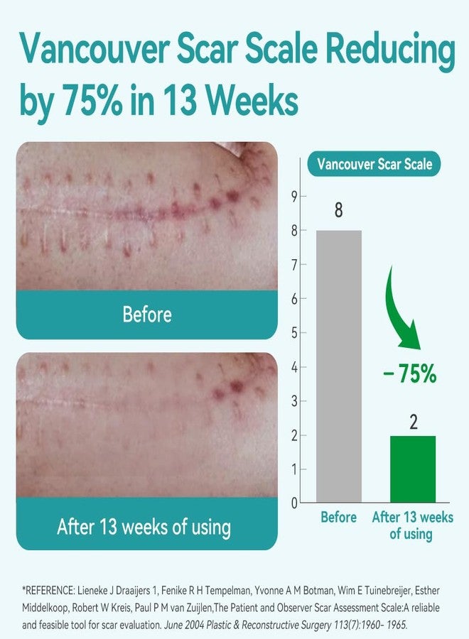 Dimora Medical Grade Silicone Scar Sheets -Hypoallergenic Silicone Scar Tape (1.6”x60" Roll), Ultra-soft Scar Removal Treatment for Surgical Scars, C Section, Tummy Tuck, Keloid Treatment - Image 3