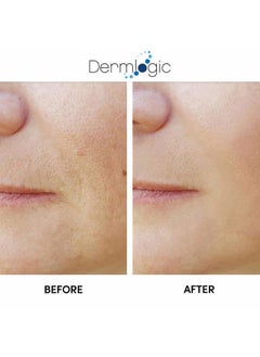 Dermlogic Anti Aging Resurfacing Peel Pads - Contains Salicylic, Glycolic, & Lactic for Face & Body. Includes Hyaluronic, & Witch Hazel, Green Tea & Aloe Vera. Exfoliates to Correct Dark Spots & Scars.  - Image 5