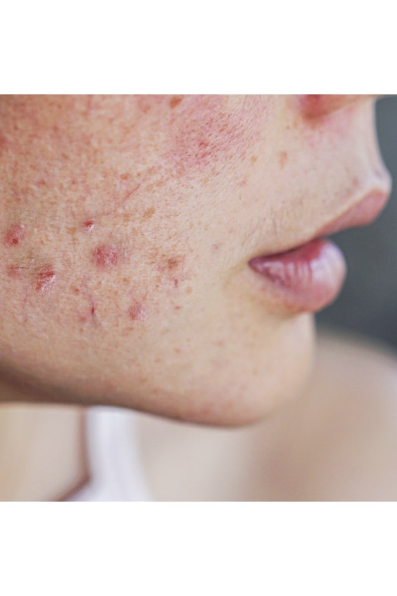 Mesoestetic Blemiderm Pack - Professional Use Anti-Blemish 1unit - Image 4