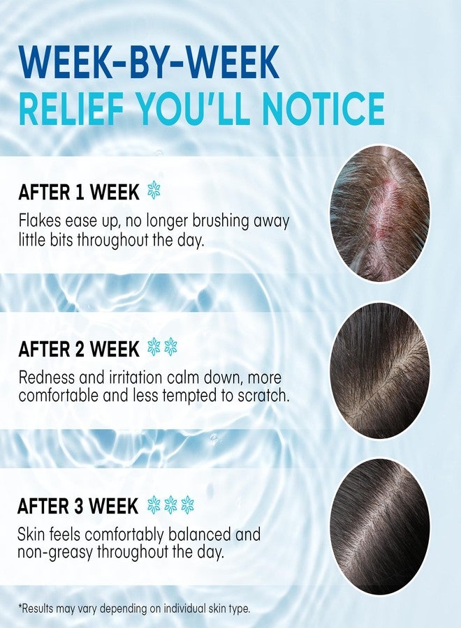 Roycederm Seborrheic & Psoriasis Calming Serum: Clinically Inspired Care for Itch, Dryness, Redness & Flaking - Seborrheic Dermatitis & Psoriasis Scalp Treatment Suitable for Scalp, Face & Body - Image 5