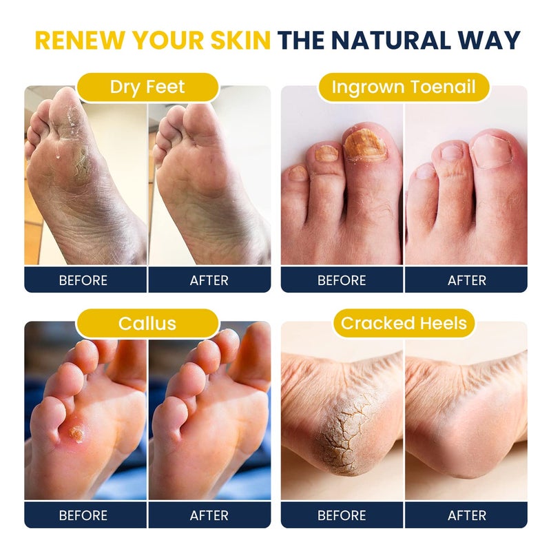 Foot Cure علاج القدمين نقع القدم بالحمضيات مع أملاح إبسوم لجلد القدم المتصلب، تعزيز المناعة، أظافر القدم التالفة، قدم الرياضي، باديكير وتهدئة الأقدام المتعبة المؤلمة - 16 أونصة (عبوة من 2) - Image 4