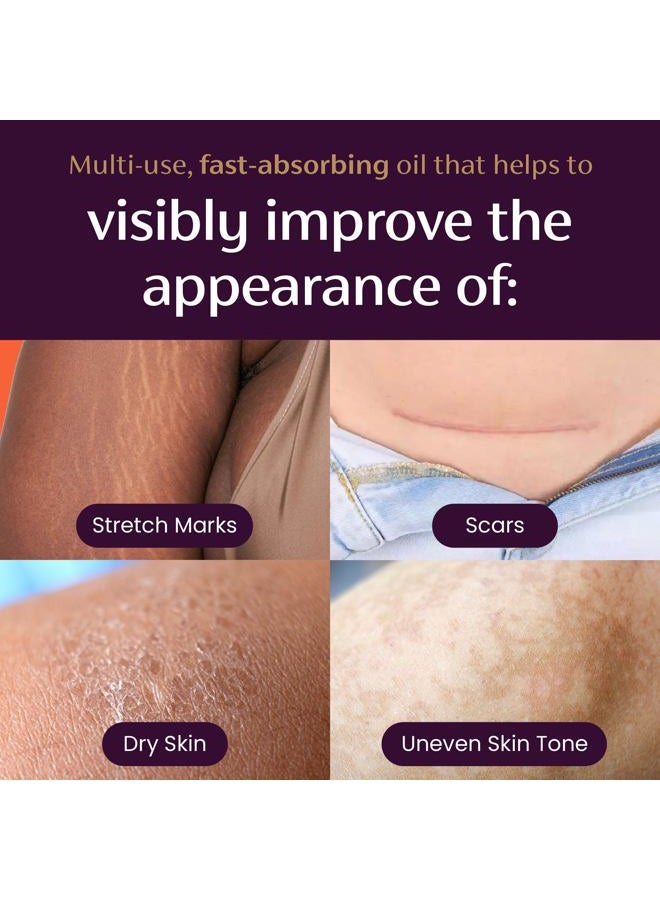 Mederma زيت سريع الجفاف - علاج الندبات وعلامات التمدد، يحسن المظهر مع مستخلصات نباتية طبيعية، خالي من البارابين، سريع الامتصاص، يرطب البشرة الجافة، يقلل من تفاوت لون البشرة، 2.02 أونصة (60 مل) - Image 2