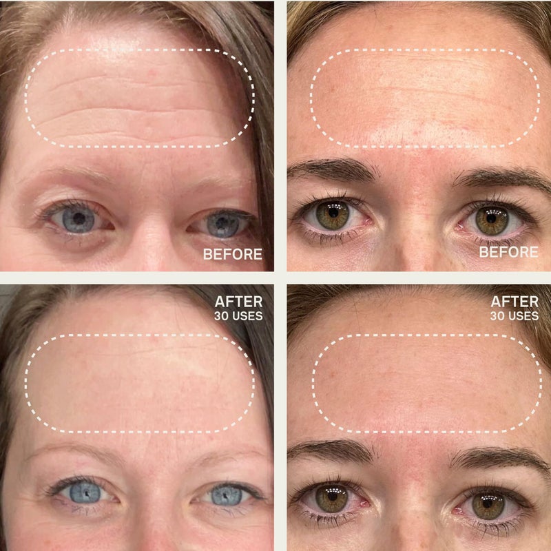 Dermaclara Forehead Patch - Forehead Wrinkle Patches for Face Overnight, Dermaclara Silicone Patches, Reusable for Face, Treatment for Wrinkles, Repair & Restore, Up to 30 Uses - 1 Patch - Image 3