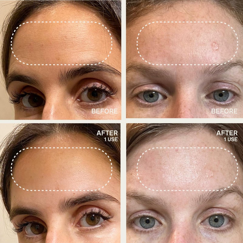 Dermaclara Forehead Patch - Forehead Wrinkle Patches for Face Overnight, Dermaclara Silicone Patches, Reusable for Face, Treatment for Wrinkles, Repair & Restore, Up to 30 Uses - 1 Patch - Image 5