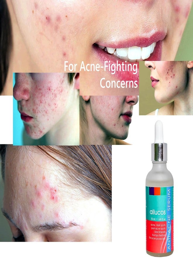 ALLUCOS Anti Acne Face Serum - Acne Prone Skin, Rosemary | Plant Based Ingredients | Women and Men | Sulphate & Paraben-free| Herbal Serum | 50ml (Pack of 1) - Image 4
