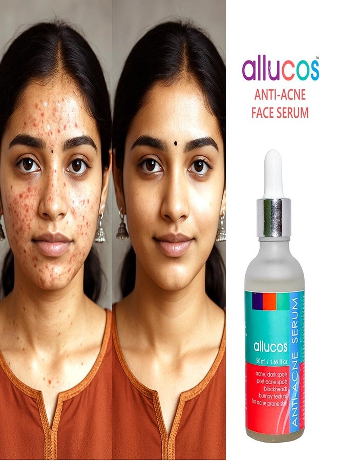 ALLUCOS Anti Acne Face Serum - Acne Prone Skin, Rosemary | Plant Based Ingredients | Women and Men | Sulphate & Paraben-free| Herbal Serum | 50ml (Pack of 1) - Image 2