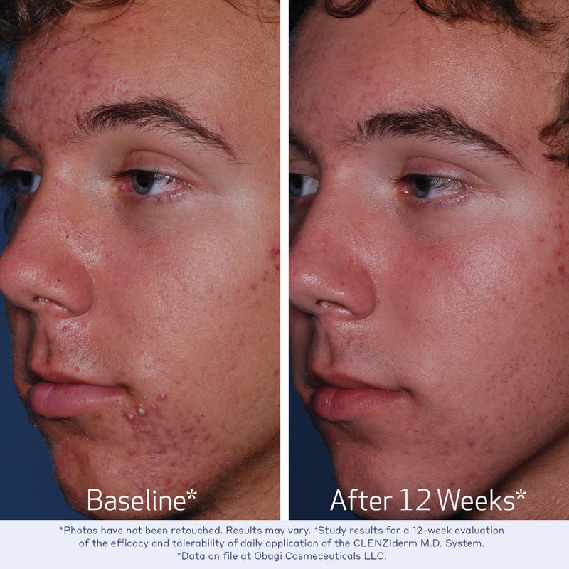 Obagi Medical Obagi CLENZIderm M.D. Therapeutic System - 3 Step Acne Treatment System Includes 2% Salicylic Acid (BHA) Cleanser, 2% Salicylic Acid (BHA) Exfoliating Toner, 5% Benzoyl Peroxide (BPO) Acne Treatment - Image 4