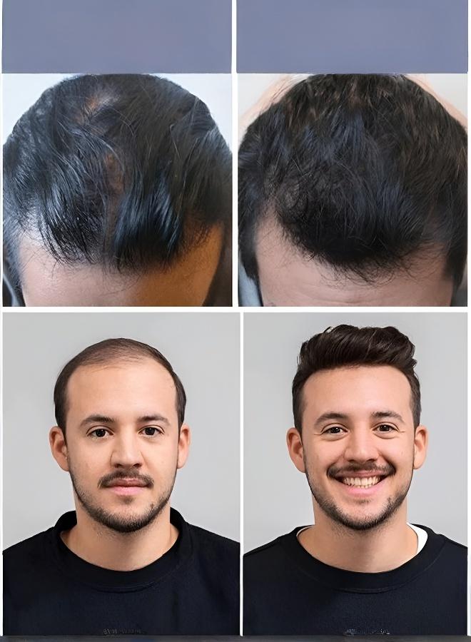Men's forehead hairpiece, specially designed for thinning hairlines, crafted from real human hair, seamless on the forehead, perfectly covers bald areas, suitable for daily wear and pairing with wigs. - Image 3