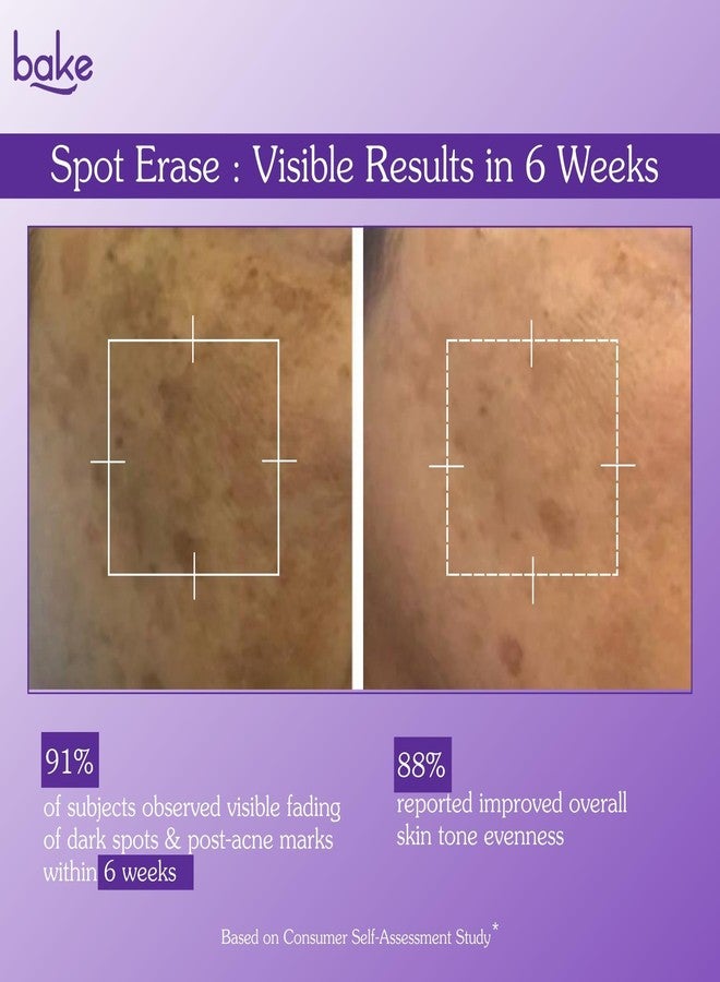 BAKE Spot Erase™ Dark Spot Correcting Serum Cream with 5% Azelaic Acid, 3% Kojic Acid Dipalmitate | Reduces Dark Spots, Melasma, Post Acne Marks & Pigmentation | 1.5% Alpha Arbutin | For All Skin Types - 30g - Image 4