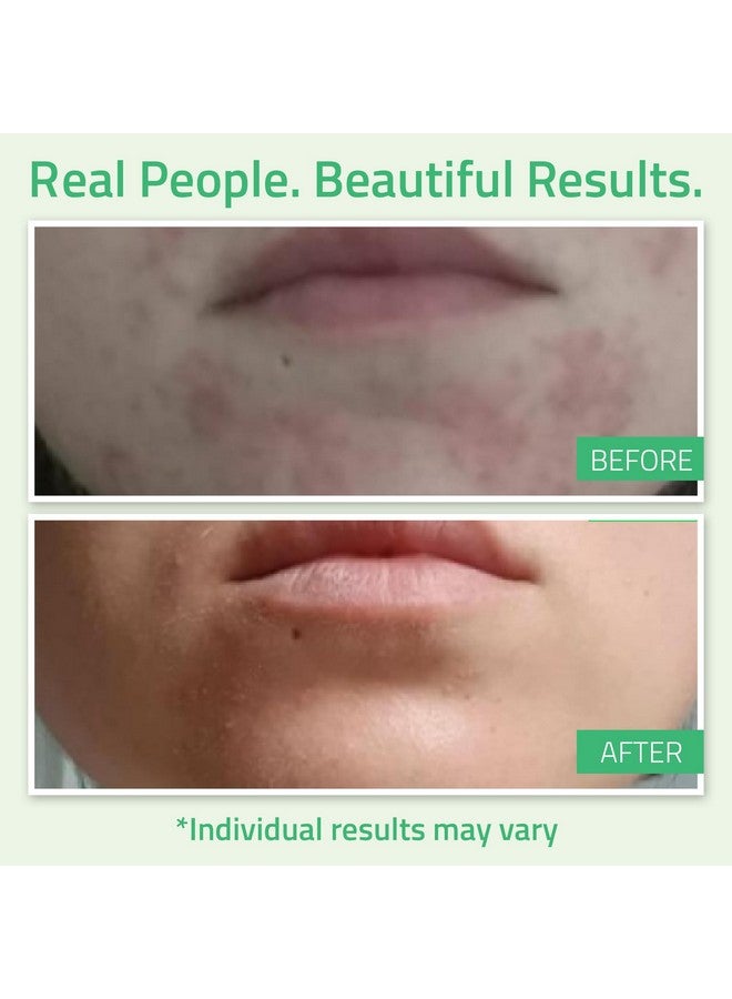 YEOUTH Glycolic Acid Gel Peel for Face - Exfoliatingg Gel for Face - 30% Glycolic Acid Peel - 30% Gel with Retinol & Green Tea - Face Peel Designed to Refresh & Smooth the Appearance of Skin 1oz - Image 4