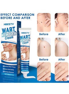 HBESTY Wart Remover Ointment, Advanced Formula Wart Cream Gentle Safe And Effective Removal Of Corn And Callus, For Plantar Wart Flat Warts And Corns, 100 % Natural Herbal 20G  - Image 2