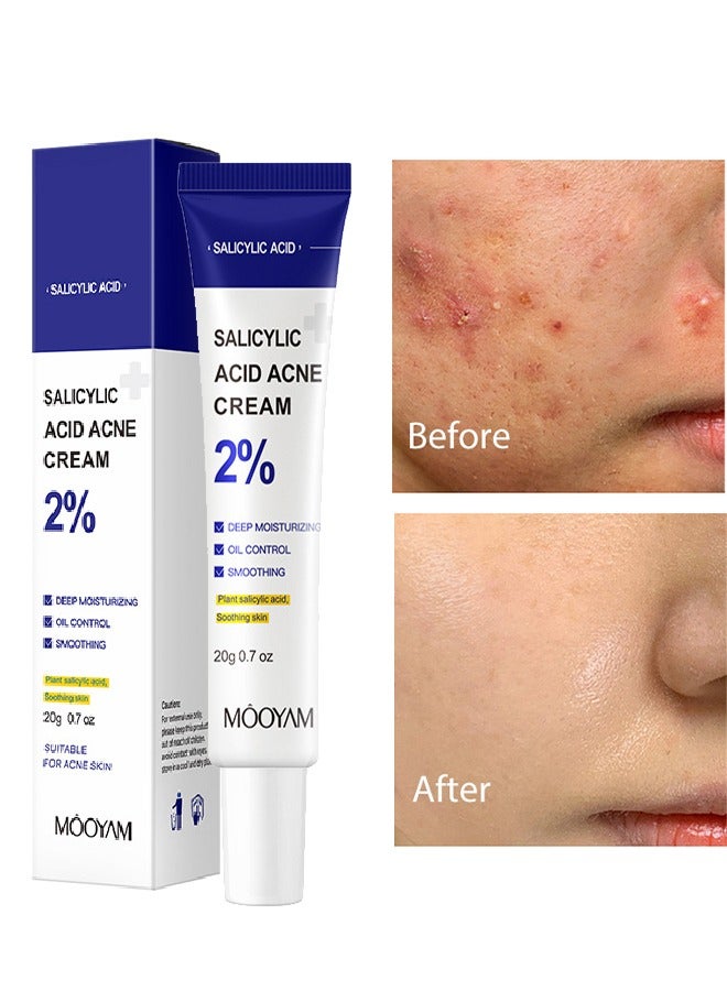 MOOYAM Salicylic Acne Cream- Lighten Acne Marks Remove Acne Shrink Pores Plant Essence - Fast Acne Removal in 12 Hours to See Results 20g  - Image 1
