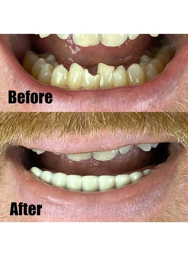 Billy-Bob Billy-Bob Instant Smile Teeth Lower Veneer  - Image 3