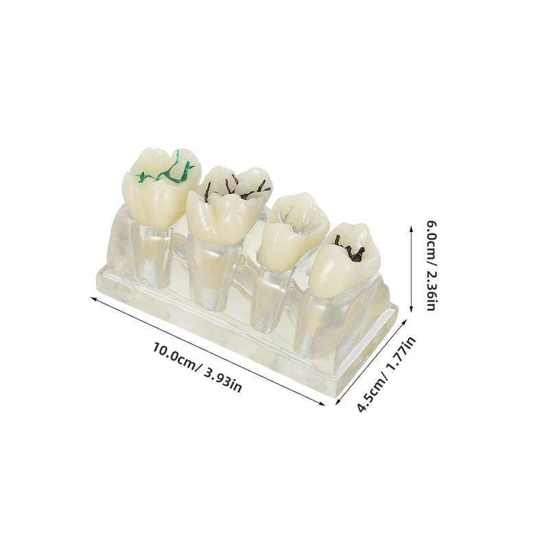 KSA market popular practical build Oral Caries Tooth Model - 4 Times Oral Study Model for Health Education Teachers and Clinical Demonstration Purposes - Detachable Decayed Teeth Prop New residential zone delivery Dust proof Neat shape Reliable local delivery service Main road full logistics cover Medium weight Daily wear upgraded resistant material Globally selected raw material Globally engineered build Global trendy simple build Multi-style matching design Global mainstream design picks Light precision processed material Organized shipment arrange Popular practical build UV resistant Efficiency boosted construction Domestic distribution ready Shop & home all-space compatible Experience optimized build KSA standard compatible design Bulk storage easy optimized build Fast intercity distribution Air & land transit compatible - Image 5