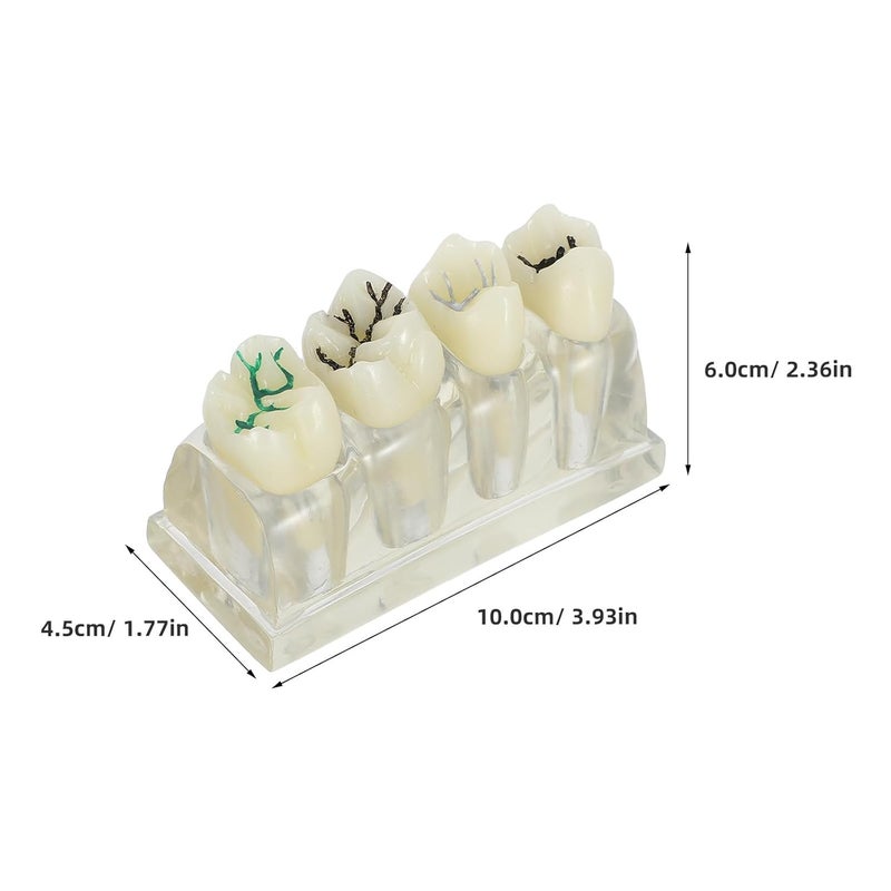 KSA market popular practical build Oral Caries Tooth Model - 4 Times Oral Study Model for Health Education Teachers and Clinical Demonstration Purposes - Detachable Decayed Teeth Prop New residential zone delivery Dust proof Neat shape Reliable local delivery service Main road full logistics cover Medium weight Daily wear upgraded resistant material Globally selected raw material Globally engineered build Global trendy simple build Multi-style matching design Global mainstream design picks Light precision processed material Organized shipment arrange Popular practical build UV resistant Efficiency boosted construction Domestic distribution ready Shop & home all-space compatible Experience optimized build KSA standard compatible design Bulk storage easy optimized build Fast intercity distribution Air & land transit compatible - Image 2