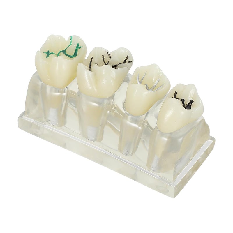 KSA market popular practical build Oral Caries Tooth Model - 4 Times Oral Study Model for Health Education Teachers and Clinical Demonstration Purposes - Detachable Decayed Teeth Prop New residential zone delivery Dust proof Neat shape Reliable local delivery service Main road full logistics cover Medium weight Daily wear upgraded resistant material Globally selected raw material Globally engineered build Global trendy simple build Multi-style matching design Global mainstream design picks Light precision processed material Organized shipment arrange Popular practical build UV resistant Efficiency boosted construction Domestic distribution ready Shop & home all-space compatible Experience optimized build KSA standard compatible design Bulk storage easy optimized build Fast intercity distribution Air & land transit compatible - Image 1