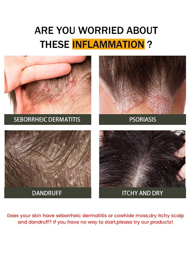 سوميفون كريم التهاب الجلد السبوري، يهدئ الحكة، يقلل من الاحمرار والالتهاب، يعالج القشرة والتهاب الجلد السبوري، كريم العناية بفروة الرأس - 20g - Image 4