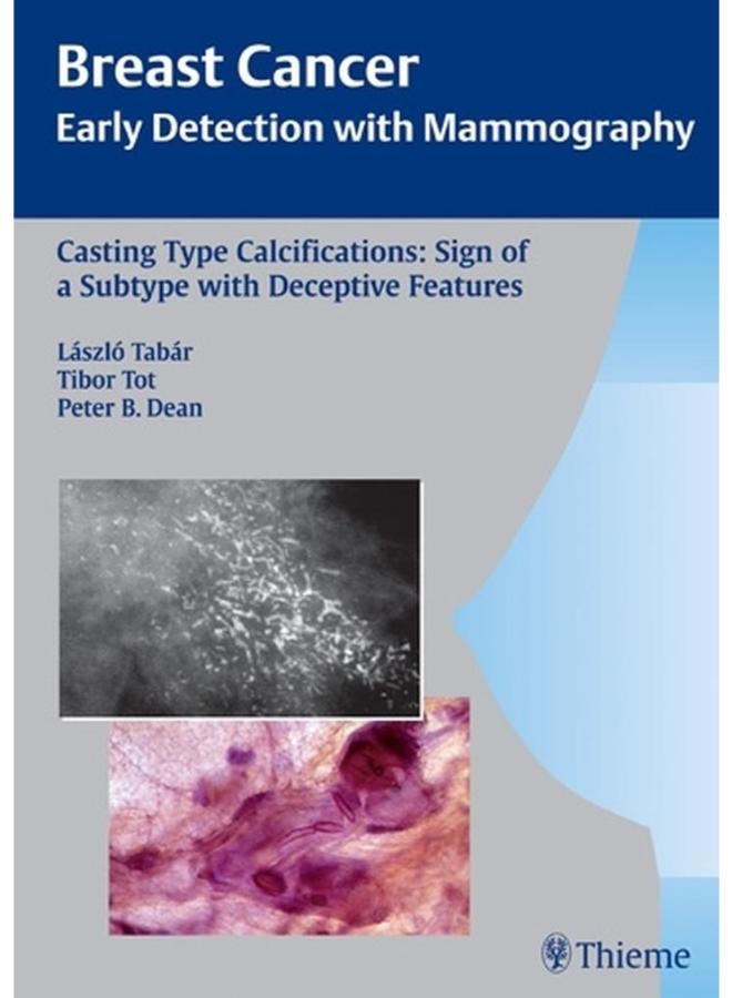 Casting Type Calcifications: Sign of a Subtype with Deceptive Features: v. 2