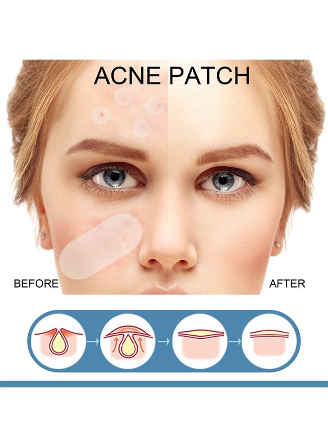 EELHOE Acne Patch - 5 Sizes Of Patch Healing Acne And Pustule Can Be Used Day And Night , Acne patch can be made up IOnvisible Acne-Clearing Anti-acne-Closing Acne Waterproof Concealer Hydrocolloidal Acne Patch 80 Patches - Image 4