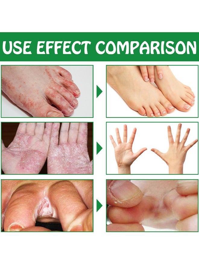 SOUTH MOON - Hand Ringworm BeriBeri Fungus Spray, Anti-Fungi Treatment For Feet Itchy, Sweating, Peeling And Blisters, Natural Ingredients Foot Fungi Spray For Tinea Pedis, Inflamed, Feet Smelly 30ML - Image 1