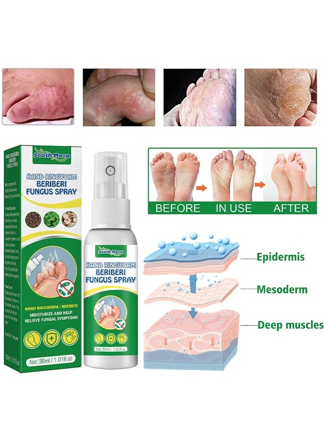 SOUTH MOON - Hand Ringworm BeriBeri Fungus Spray, Anti-Fungi Treatment For Feet Itchy, Sweating, Peeling And Blisters, Natural Ingredients Foot Fungi Spray For Tinea Pedis, Inflamed, Feet Smelly 30ML - Image 1