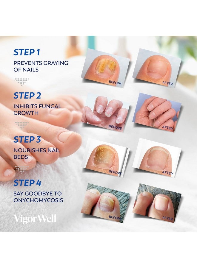 VigorWell Toenail Fungus Treatment Extra Strength - (Medium) 32 Nighttime Hydrogel Patches for Overnight Toenail Repair - Visible Results in 8 Hours - Fungal Nail Patches for Toenail Fungus Relief - Image 4