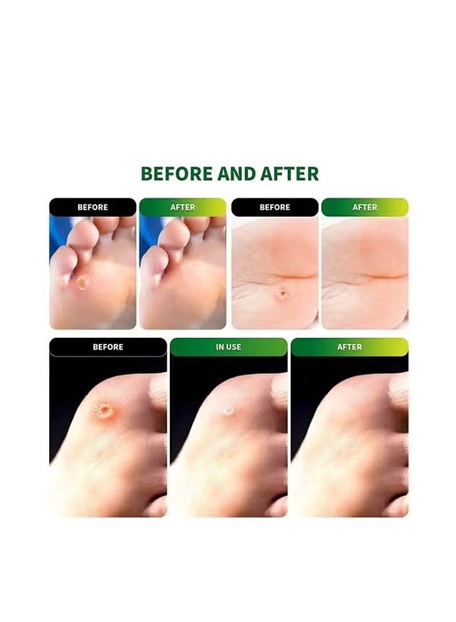 سوميفون ٥٤ ضمادة لإزالة مسامير القدم، علاج للعناية بالقدمين من مسامير القدم والكالو، ضمادة لإزالة مسامير القدم، تخفف آلام مسامير القدم والبثور وفرك الكعب. - Image 2