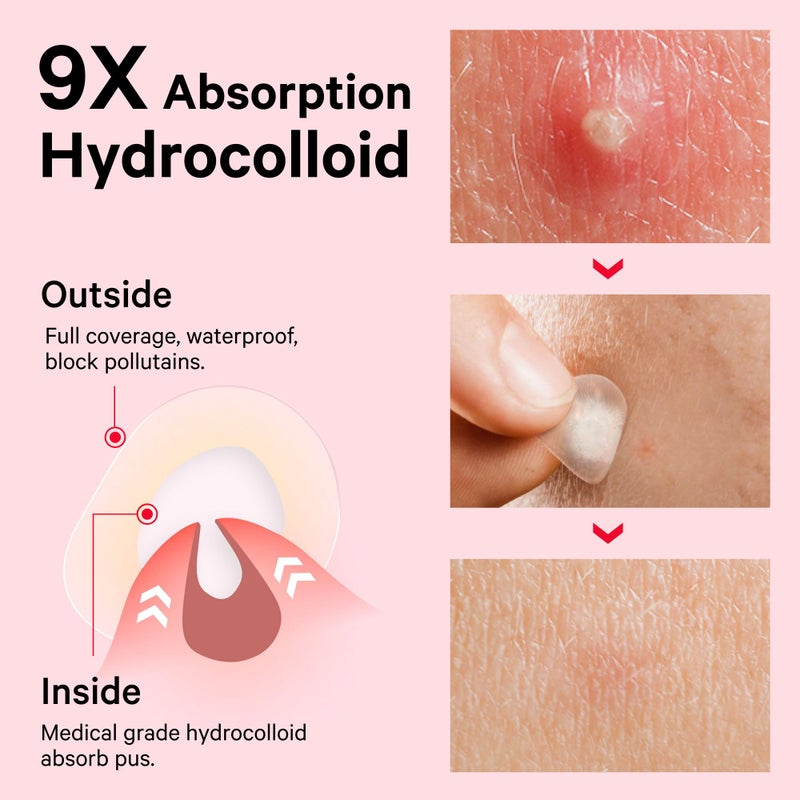 Sosky Pimple Patches for Face, Invisible Hydrocolloid Acne Patches, HSA Store Eligible Items, Zit Sticker for Face and Skin, Pimple Sticker for Covering Zits, Blemishes with Salicylic Acid 48 Count - Image 3