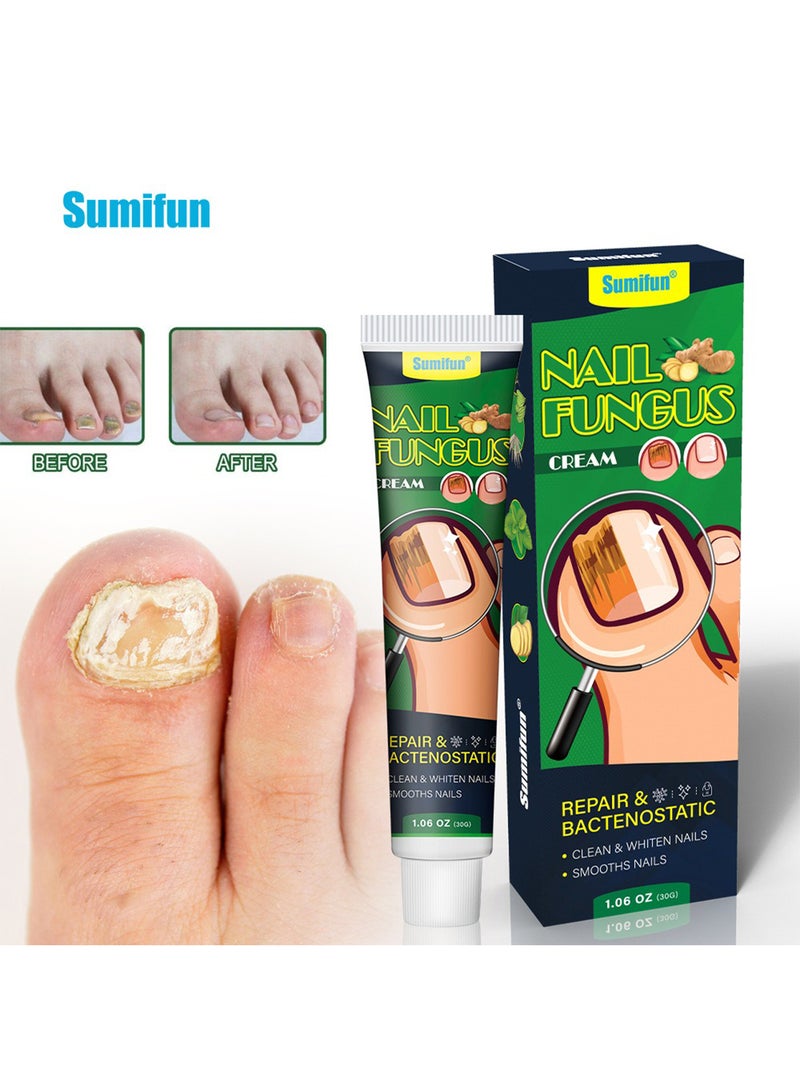 سوميفون كريم فطريات الأظافر، كريم إصلاح الأظافر بقوة إضافية، كريم علاج فطريات أظافر القدم، ينظف ويبيض وينعم الأظافر، ويصلح البكتيريا 30 جم - Image 1