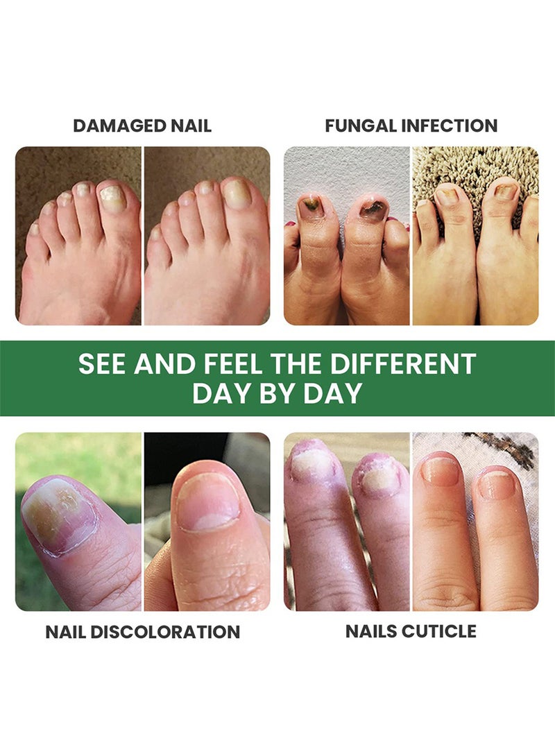 سوميفون كريم فطريات الأظافر، كريم إصلاح الأظافر بقوة إضافية، كريم علاج فطريات أظافر القدم، ينظف ويبيض وينعم الأظافر، ويصلح البكتيريا 30 جم - Image 4