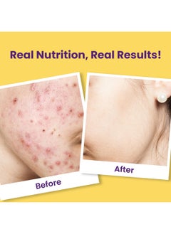 CHICNUTRIX Super C Acne Free Clear Skin  - Image 4