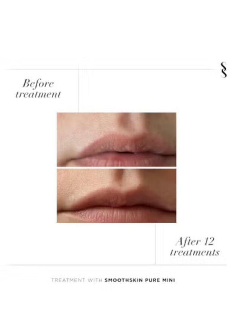 سموث سكن  Smoothskin - جهاز إزالة الشعر بالليزر Pure Mini Lite Lilac IPL، يدوم طويلاً، لإزالة الشعر من الجسم والبكيني والوجه، بديل لليزر وماكينة الحلاقة للبكيني، تم اختباره سريريًا وحصل على موافقة إدارة الغذاء والدواء - Image 5