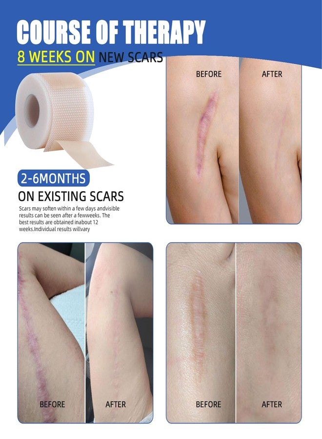 Nepia Silicone Scar Sheets 1.6"x120" Roll (3M) - Medical Grade | Reusable Scar Tape to Flatten & Fade Surgical Scars, C-Section, Keloids, Burns | Hypoallergenic Treatment (Clear) - Image 5