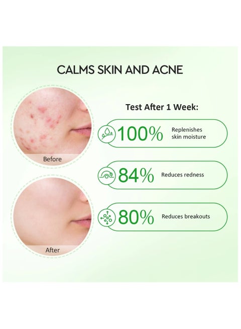 Glad2Glow Glad2Glow Acne Set Moisturizer Gel Repair Skin 55g + Acid Power  Clear Acne Serum 17ml | Best Price UAE | Dubai, Abu Dhabi