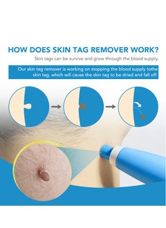 Sefudun Wart Removal Tool Skin Tag Removal Double Head Blue  - Image 2