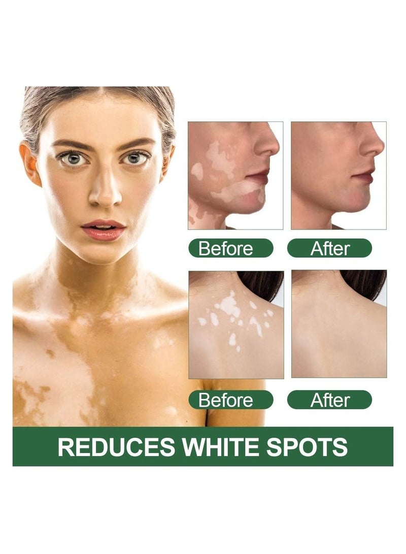 Sumifun Vitiligo Care Cream Reduces White Spots on Skin, Pigmentation regulating, Improve Skin Pigmentation, 4 Counts Upgraded Vitiligo Creams - Image 5