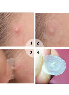 Breylee 22-Piece Invisible Acne Pimple Patch Set  - Image 3