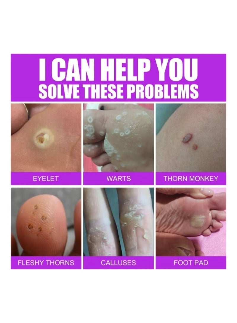 SOUTH MOON Remove chicken eye lotion Extra freckles Remove chicken calluses skin care foot pad - Image 4