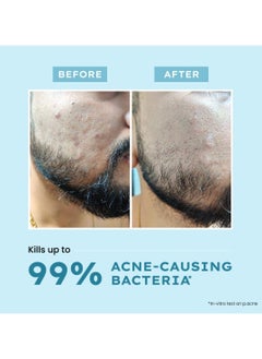 HYPHEN Acne Fix Spot Corrector for Acne Prone Skin with Salicylic Acid 1%, Azelaic Acid 10% | Shrinks active acne, Prevents new pimple, Soothes acne, Conceals Redness | For Men & Women - 15g  - Image 5
