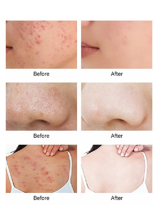 RtopR Mango Acne Cream,Acne Treatment Face Cream, Acne Spot Treatment for Face and Acne Dots, Natural Cystic Acne Treatment, For All Skin Types, Premium Acne Scar Cream and Pimple Remover 15g  - Image 4