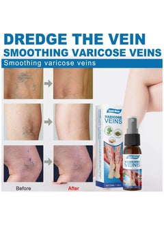 SOUTH MOON Veinhealing Varicose Veins Treatment Spray and Cream: Your Comprehensive Solution for Soothing Legs, Treating Varicose and Spider Veins Effectively  - Image 4