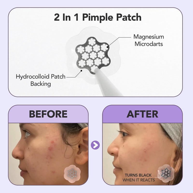Free Go Magnesium Blemish Microdarts | Pimple Patch | Fast-Acting | Quick Calming | 99.9% Pure Magnesium | Madecassic Acid | Tea Tree | Eucalyptus Leaf | Hydrocolloid Spot Care Patch (Large 6 Patches) - Image 5