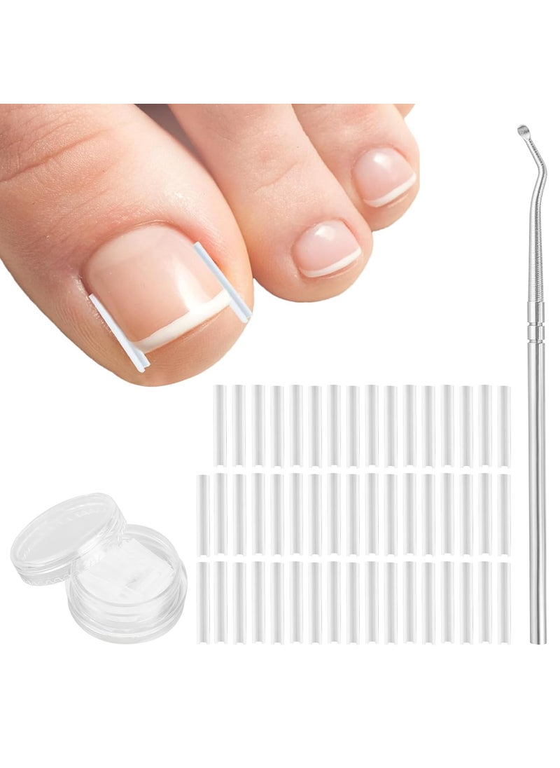 Aster (50+1) Pcs Ingrown Toenail Corrector Treatment Set, Professional Pain-Free Ingrown Toenail Removal Kit with Toenail Lifter, Easy Fixed Ingrown Toenail Tool, Toenail Straightener Strip for Men Women 