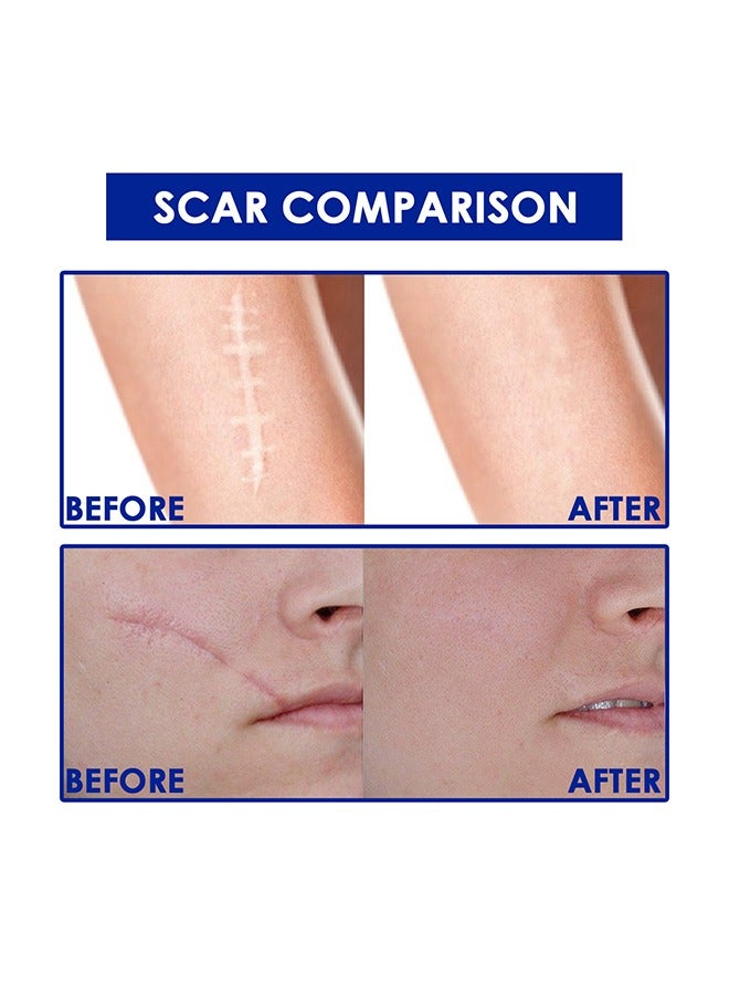 Dermatix Advanced Scar Formula with Innovative CPX Technology and Unique Vitamin C Ester, Advanced Scar Gel 15g For Cosmetic Improvement of Scars, Fast Drying and Unique Silicone Gel Formulation, Used For Treatment of Keloids, Surgical and Hypertrophic Scars, Suitable For Sensitive Skin - Image 5