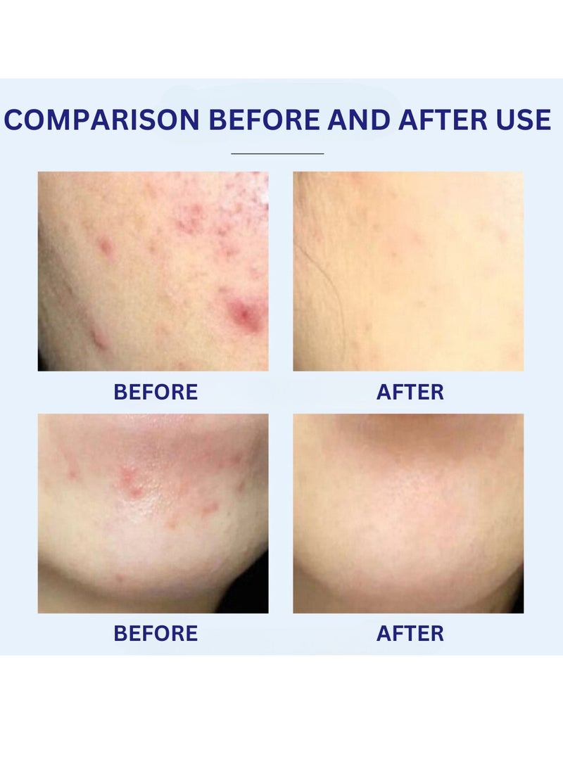 HEALMUSZ - Acne Removing Cream Acne Treatment Cream Skin Care and Cleansing Clear Face and Body Acne Blemish Cream for Acne and Blackheads Pimple Treatment Cream Natural Moisturizing Cream 20g - Image 1