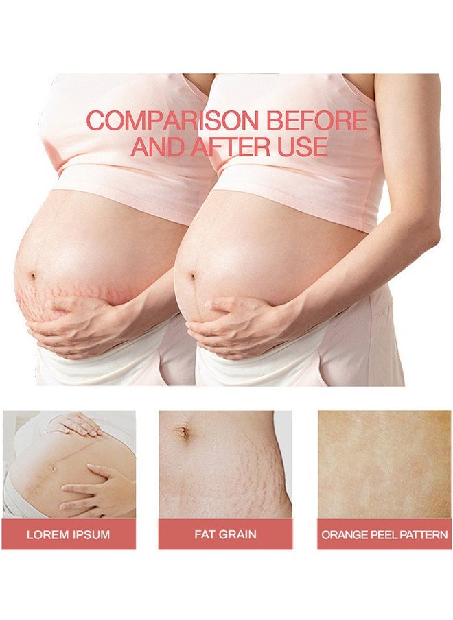 CARVENCHY - Stretch Mark Oil ,100% Natural Pure Plant Extract 30ML,Stretch Marks Remover, Essential Oil Skin Care Treatment For Stretch Mark,Removal Maternity Slackline & Scar Removal - Image 1