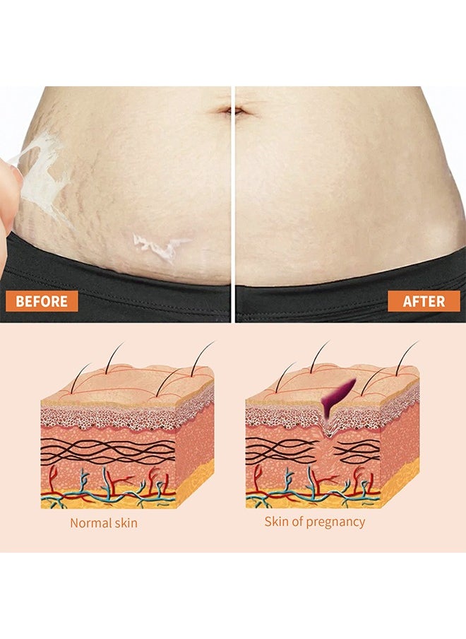 CARVENCHY - Stretch Mark Oil ,100% Natural Pure Plant Extract 30ML,Stretch Marks Remover, Essential Oil Skin Care Treatment For Stretch Mark,Removal Maternity Slackline & Scar Removal - Image 1